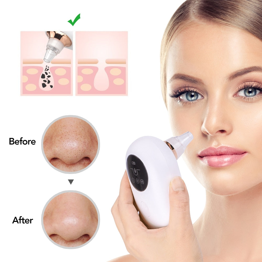 BODIMODI Blackhead Remover Deep Pore Vacuum Cleanser